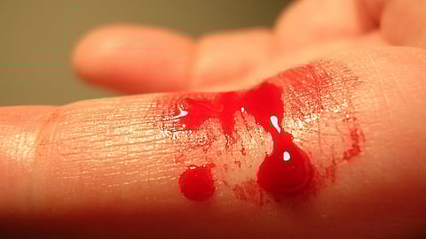 Close-up image of a bleeding finger.