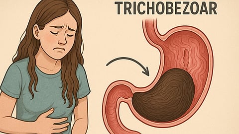 A teenage girl has a massive hairball inside her stomach.