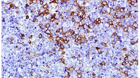 Immunohistochemical stain for CD123 highlighted plasmacytoid dendritic cells.