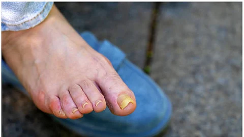 A foot with yellow overgrown nails in close-up.