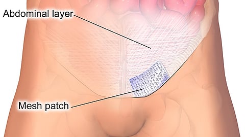 Surgical site after hernia repair, showing stitches and healing tissue on the abdomen.