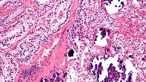 High magnification micrograph of a Xp11.2 translocation renal cell carcinoma (tRCC).
