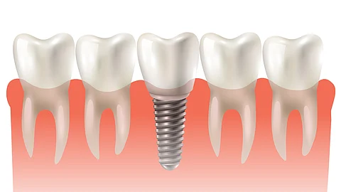 An illustration of a model of a dental implant among natural teeth.