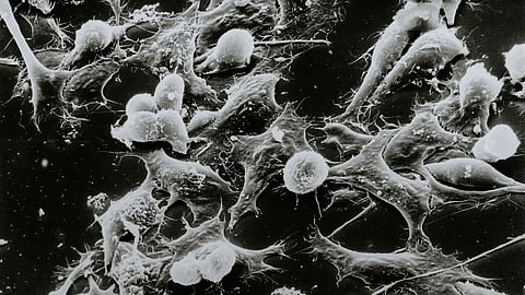 Microscopic view of cancer cells, showcasing irregular shapes and sizes, highlighting their invasive characteristics.