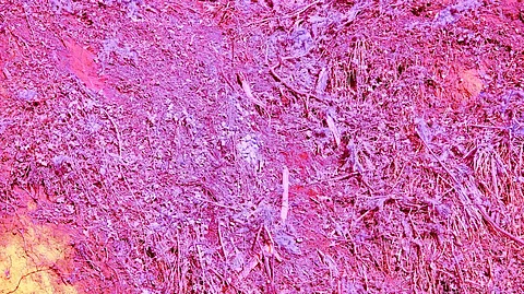 A pink background featuring an illustration of an ovarian tumor, highlighting its shape and texture
