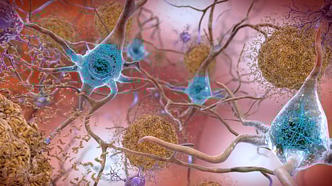 Image depicting abnormal proteins that accumulate in neurons leading to Alzheimer's disease.