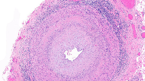 A micrograph of giant cell arteritis showing pink and purple stained cells.