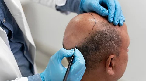 A man is getting hair transplant surgery done, and the surgeon is wearing gloves, taking measurements.