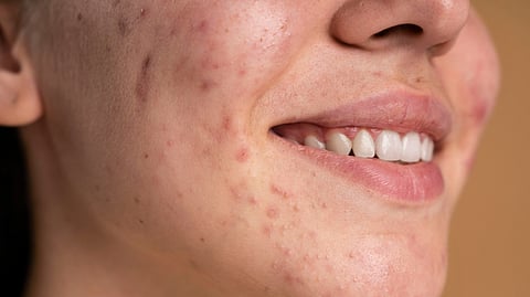 A close-up image of a smiling face with acne.