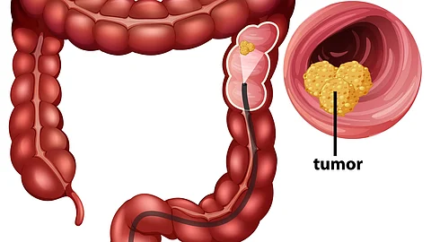 Illustration showing Colorectal Cancer.