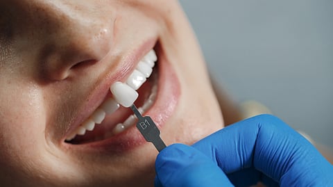 A dentist checking the color of tooth replacement using a color guide for a patient.