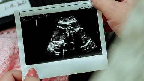 Ultrasound Picture of a fetus