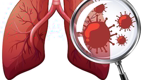A close-up illustration of a lung with some diseased condition.