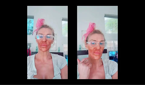 Brandi Glanville with her skin condition