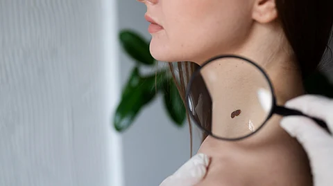 Image depicting woman suffering from melanoma.