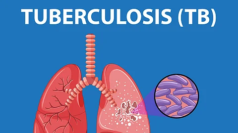 Graphics of human lung anatomy with tuberculosis(TB) infographics having blue background.