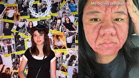 TikTok creator shows before and during pregnancy skin changes with severe facial rash.