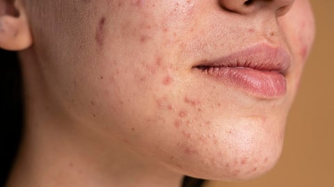 A close-up image of a young woman's face with acne.
