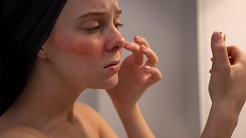 Representational image of a woman applying pimple patches.