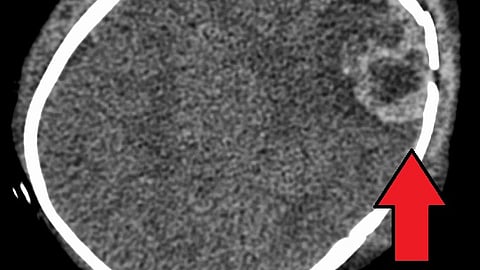 An intraparenchymal bleed with overlying skull fracture from abusive head trauma
