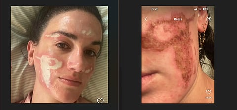 The image showing skin burns on Victoria's skin.