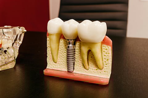 A dental implant and a natural tooth displayed on a table, illustrating dental restoration options.