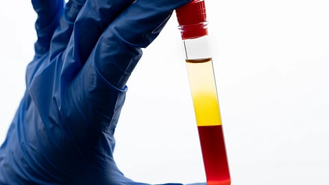 A vial of blood sample with separated components.