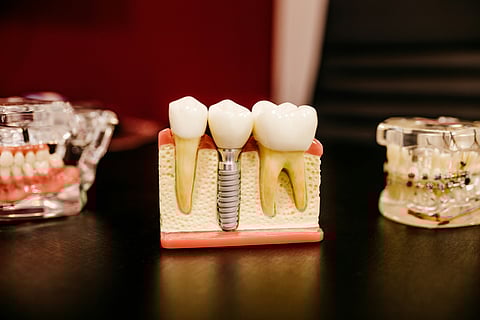An image of dental implant.