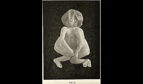 https://commons.wikimedia.org/wiki/File:Cephalothoracopagus_Janiceps_2.jpg