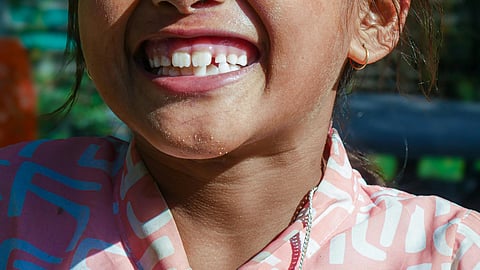 Image of a girl smiling having crooked teeth.
