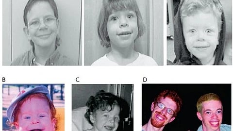 An image of kids who had williams syndrome.