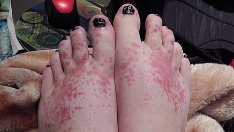 feet with Aquagenic urticaria