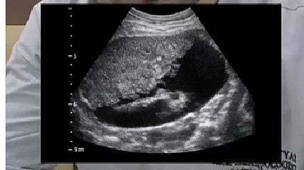 An USG image of the affected patient's abdomen with liver in focus.