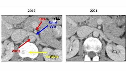 A CT scan with contrast showing the renal veins smashed between the superior mesenteric artery and the aorta.