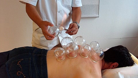 A person doing a Fire cupping procedure on the back of a male.