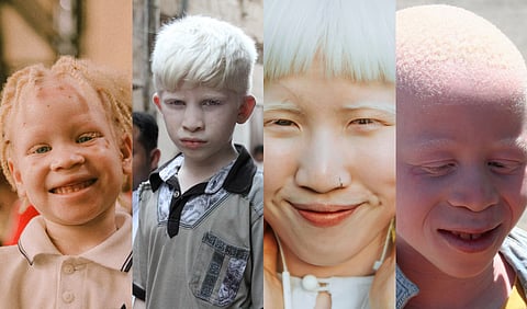 Different people with albinism