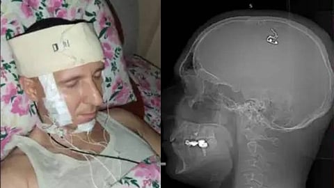 മിഖായേല് റഡുഗ, എക്സ്റേ