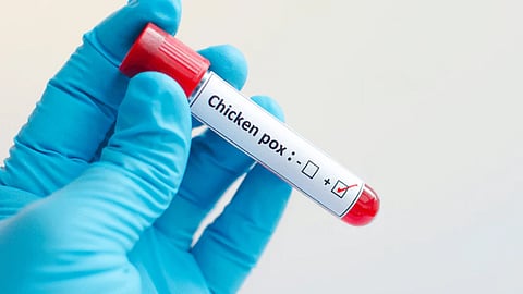 health minister issues warning against chickenpox