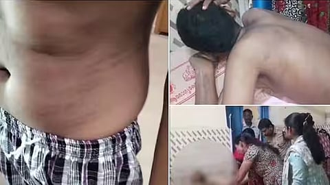 Case filed against special school principal for brutally beating differently-abled 16-year-old