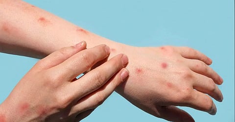 ചൂട് തുടരുന്നു; ചിക്കന് പോക്സിനെതിരേ വേണം ജാഗ്രത