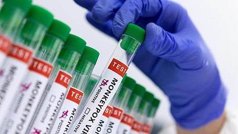 A native of Malappuram has been diagnosed with mpox