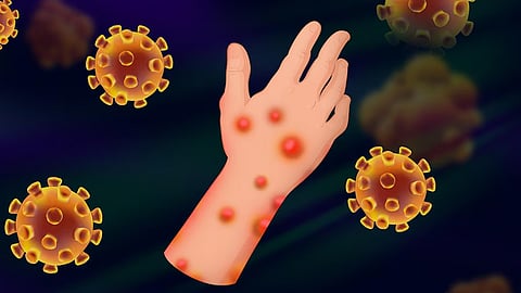 മറ്റു മൃഗങ്ങളെ ഈ രോഗം ബാധിക്കുമെങ്കിലും കുരങ്ങുകളിൽ നിന്ന് വേർതിരിച്ചെടുത്തതിനാലാണ് ഇങ്ങനെ ഒരു പേര് വന്നത് | Know Mpox take precautions explainer