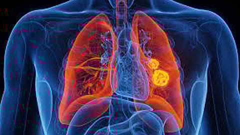 World's first urine test which promise to detect lung cancer in early stage