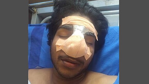 ITI student beaten up by classmate in Ottapalam; nose bone broken