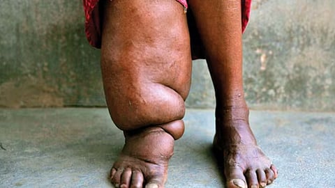 Filariasis medical camp in aster med city, discounts