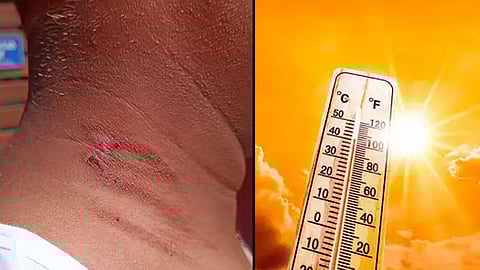 sunburn 3 injured in kerala