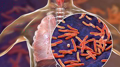 When the country reimagined the fight against tuberculosis