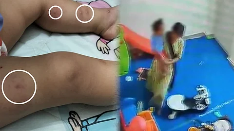 infant baby assaulted in noida daycare bite marks in body