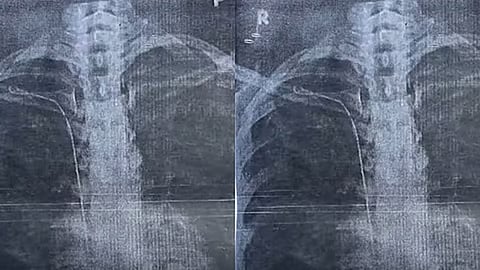 Tube gets stuck in woman's chest during surgery