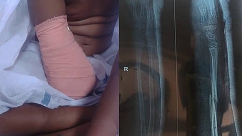 Medical error; Complaint that child's hand was amputated